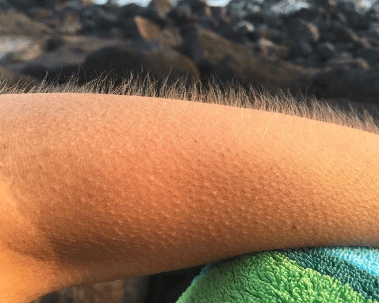 Skąd się bierze gęsia skórka?