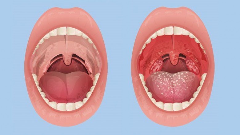 Przeziębienie a angina - czym się różnią?
