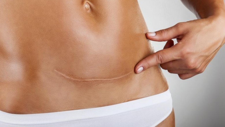 Co dzieje się podczas porodu przez cięcie cesarskie?