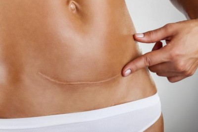 Co dzieje się podczas porodu przez cięcie cesarskie?