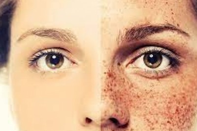 Jak pozbyć się piegów domowym sposobem? Czy piegi mogą zniknąć? Co zrobić żeby nie było piegów?