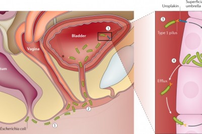 Nawracające infekcje pęcherza moczowego - przyczyny, leczenie, zapobieganie.