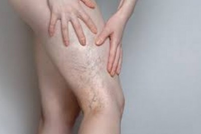 Nowoczesne zabiegi na przebarwienia oraz pajączki