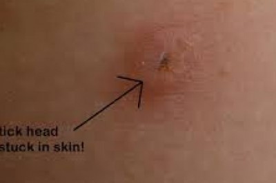Co powinniśmy zrobić, jeżeli kleszcz nie zostanie do końca wyjęty z powodu przerwania się jego tułowia?