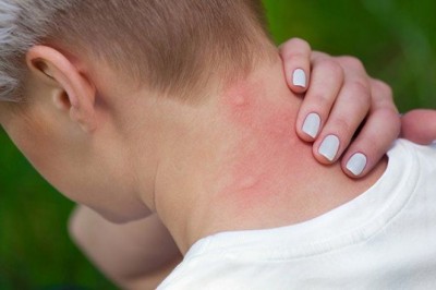 Jak złagodzić swędzenie po ugryzieniu komara?