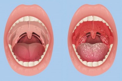 Przeziębienie a angina - czym się różnią?