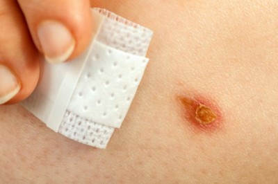 Co robić, by przyspieszyć gojenie ran, gdy mamy cukrzycę