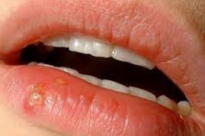 Domowe sposoby na opryszczkę. Jak się szybko pozbyć opryszczki? Czym smarować opryszczkę?