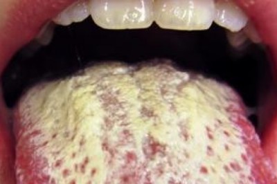 Domowy, zdrowy i ekologiczny sposób na zwalczanie pleśniawek.