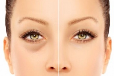 Jak zlikwidować domowymi sposobami ciemne cienie pod oczami?