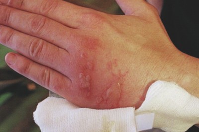 Jak domowym sposobem złagodzić oparzenie?