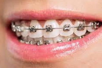 Czego nie można robić po zalozeniu aparatu? Co robić po zalozeniu aparatu? Czy można pić kawę z aparatem?