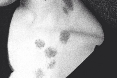 Jak szybko pozbyć się MALINKI domowymi sposobami? Jak długo utrzymuje się malinka? Czy od malinki można umrzec?