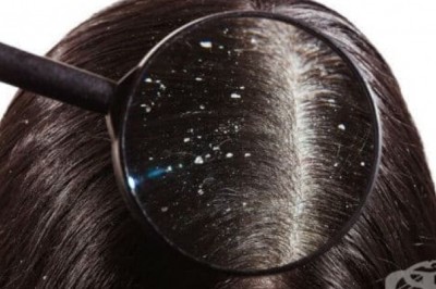 Z czego robi się łupież? Czy łupież może sam zniknąć? Jak myć włosy z łupieżem? Jakich witamin brakuje przy łupieżu? Co wzmaga łupież?