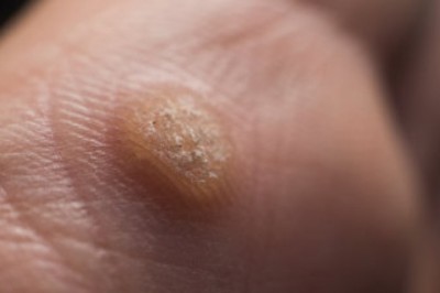 Jak pozbyć się kurzajki? Jak domowym sposobem pozbyć się kurzajek? Czy kurzajki mogą same zniknąć? Czy kurzajki są niebezpieczne?