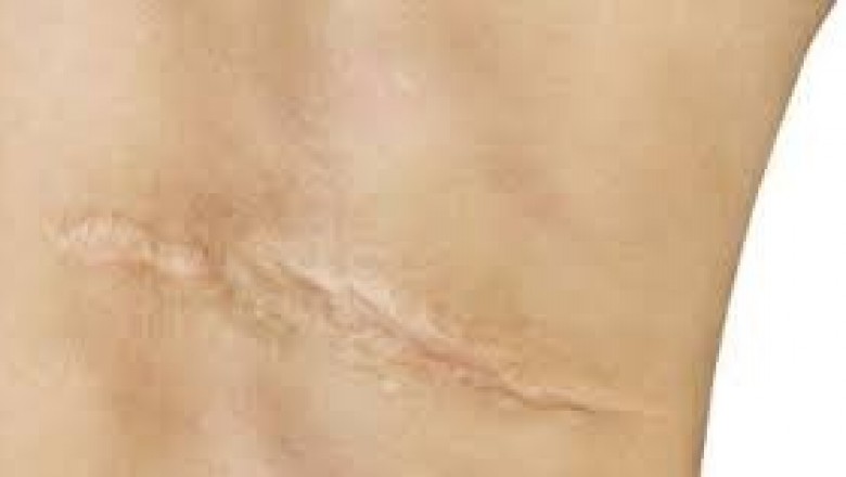 Czy da się całkowicie usunąć bliznę, czyli jak walczyć z bliznami? Jak usunąć głębokie blizny?