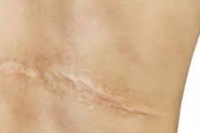 Czy da się całkowicie usunąć bliznę, czyli jak walczyć z bliznami? Jak usunąć głębokie blizny?