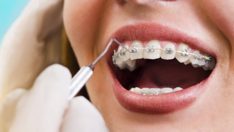 Wszystko co powinieneś wiedzieć o aparatach ortodontycznych