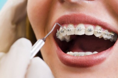 Wszystko co powinieneś wiedzieć o aparatach ortodontycznych