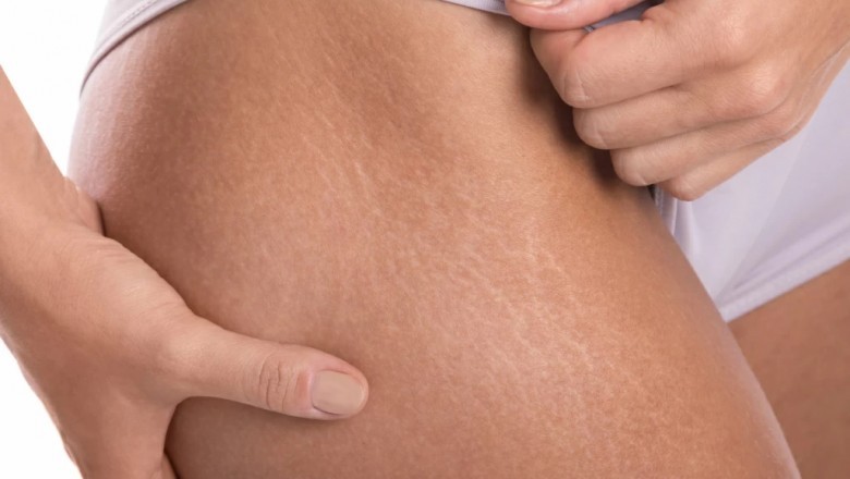 Pożegnaj rozstępy, czyli o sposobach ich usuwania.