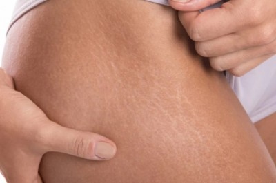 Pożegnaj rozstępy, czyli o sposobach ich usuwania.