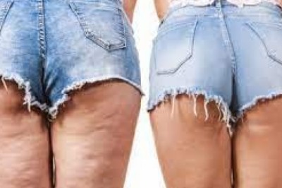 Uda i pośladki bez cellulitu - czyli jak walczyć z celulitem.