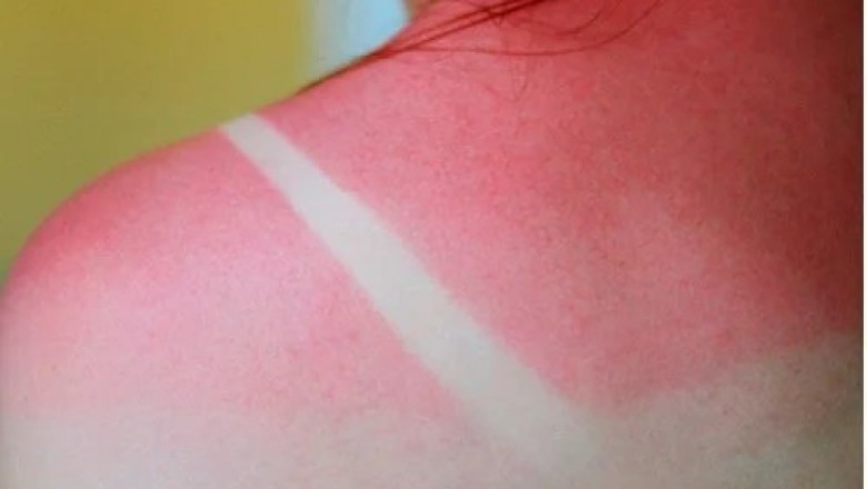 Domowe sposoby na poparzenia słoneczne