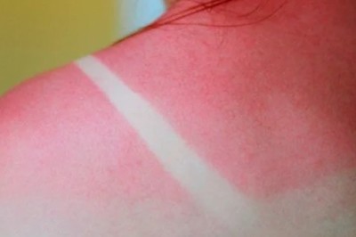 Domowe sposoby na poparzenia słoneczne