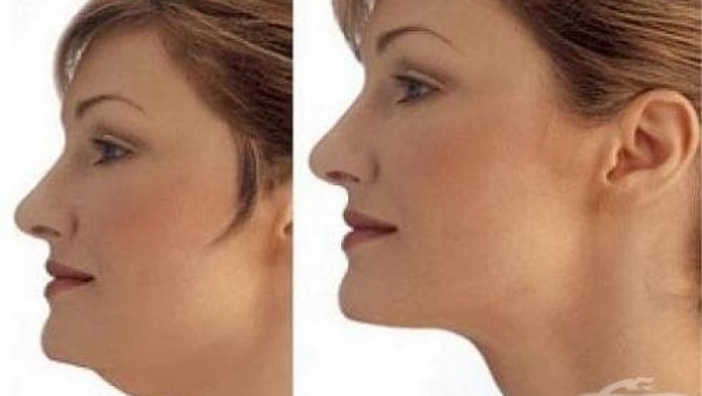 Podwójny podbródek - jak się go pozbyć domowymi oraz profesjonalnymi metodami?