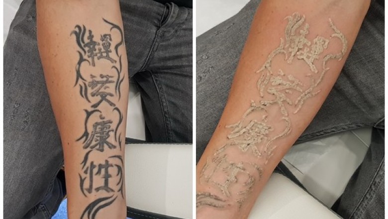 Jak pozbyć się tatuażu?